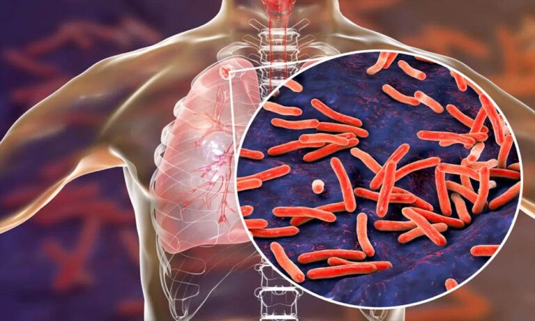 Ilustrasi mengenai gejala tuberkulosis dan cara pencegahannya